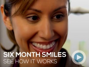Six Month Smiles Braces Grand Rapids MI Dental Services How it Works