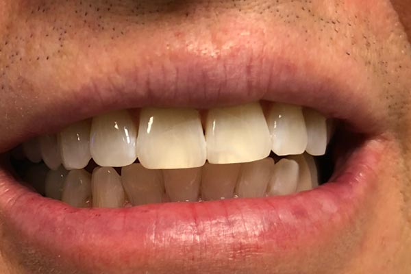 Teeth Whitening Dentist Grand Rapids