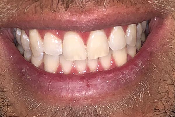Teeth Whitening Dentist Grand Rapids