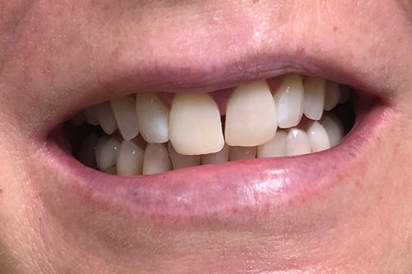Teeth Whitening Dentist Grand Rapids