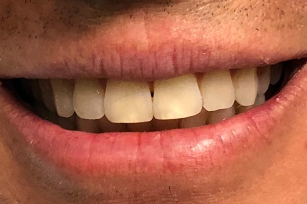 Teeth Whitening Dentist Grand Rapids