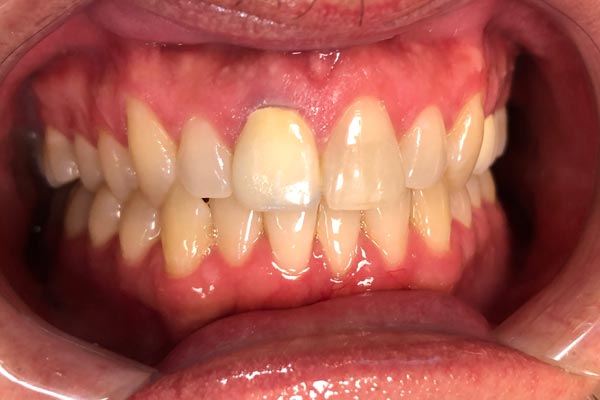 Teeth Whitening Dentist Grand Rapids MI
