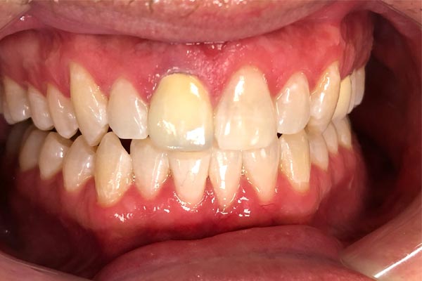 Teeth Whitening Dentist Grand Rapids MI