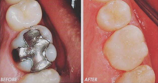 Mercury dental amalgam fillings are safe for most people